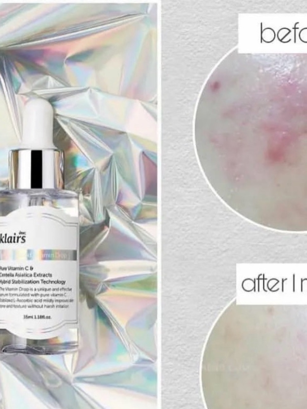 Vitamin C Serum - Clear Drop for Acne-Prone Skin (White/Clear)